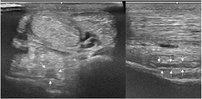 Effectiveness of Platelet-Rich Plasma and Bone Marrow Aspirate Concentrate as Treatments for Chronic Hindlimb Proximal Suspensory Desmopathy